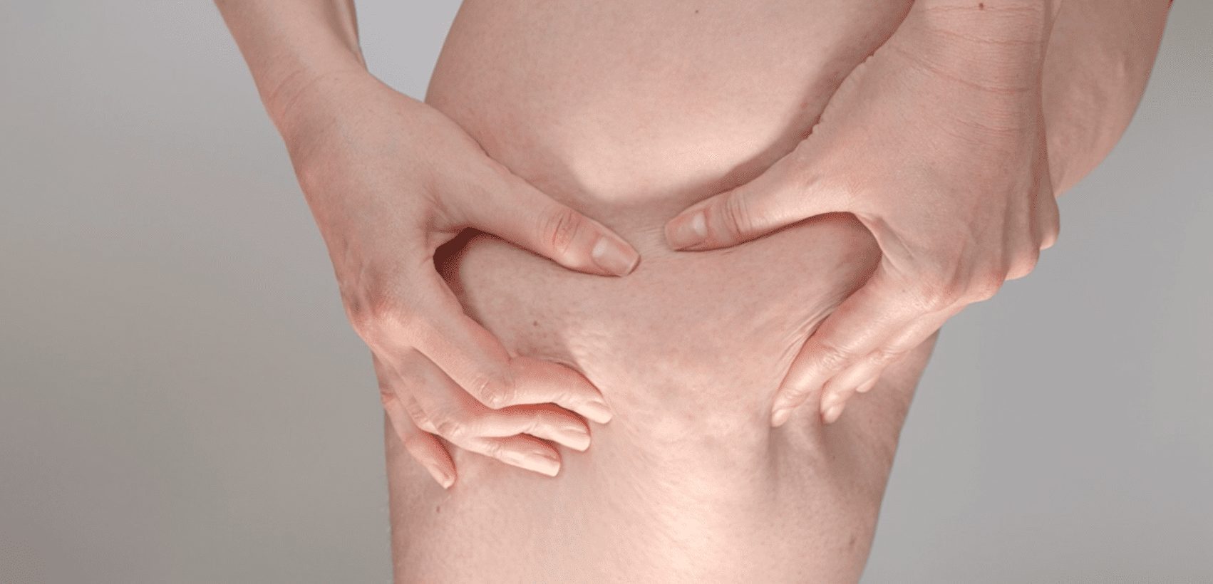 Carolina Pintos Therapy – Blog Post – Cellulite Reduction